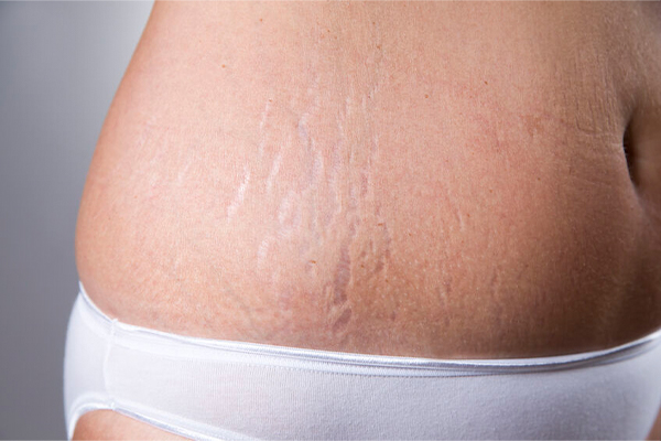 Smooth Stretch Marks with Advanced Shockwave Therapy Devices