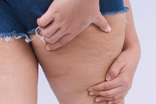 Stuck with cellulite? Just watch this tips!