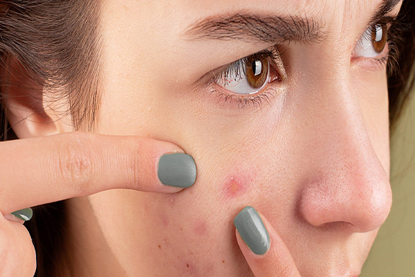 Having Many Skin Problems? You May Stop Stressing Yourself Out